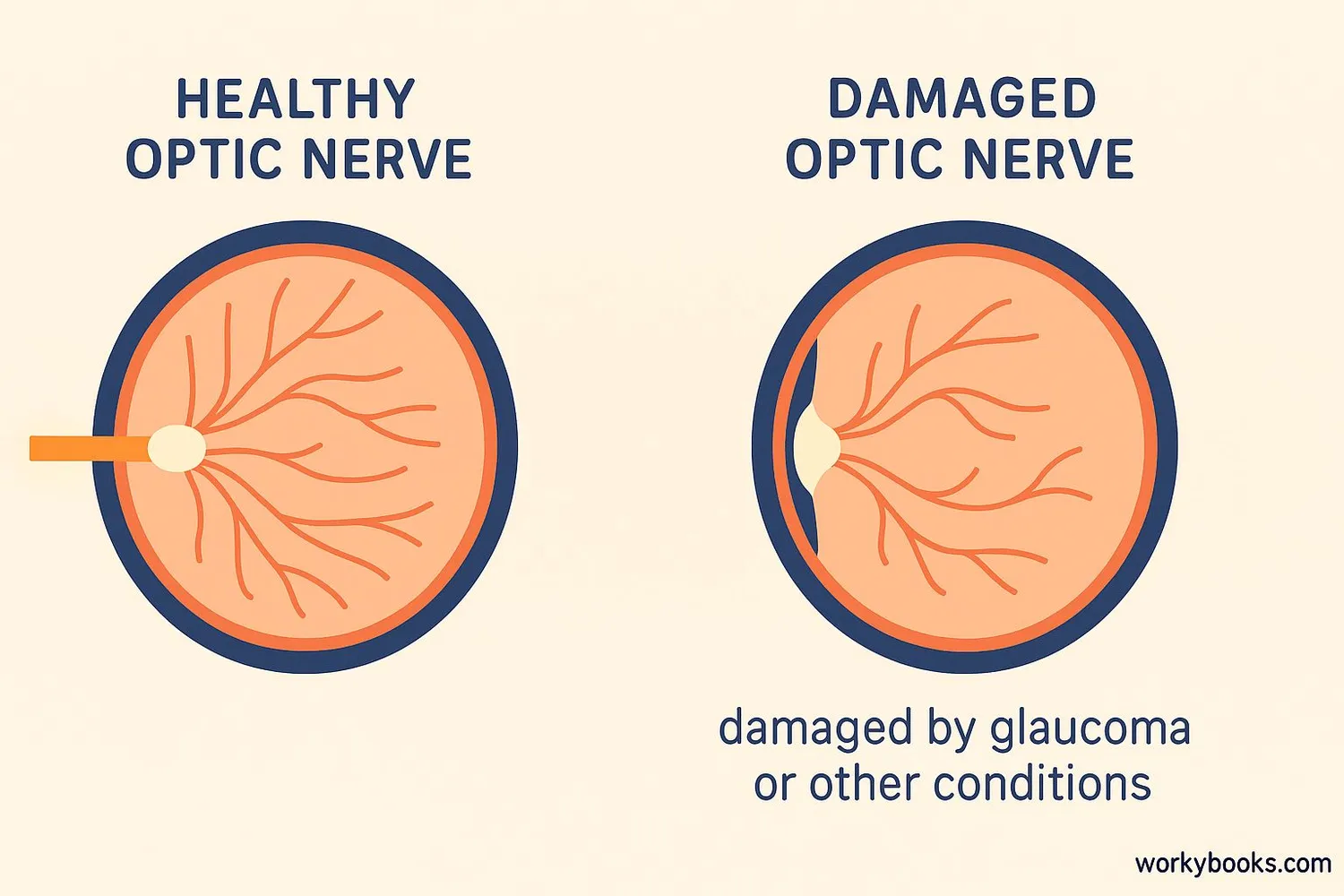 Healthy vs damaged optic nerve