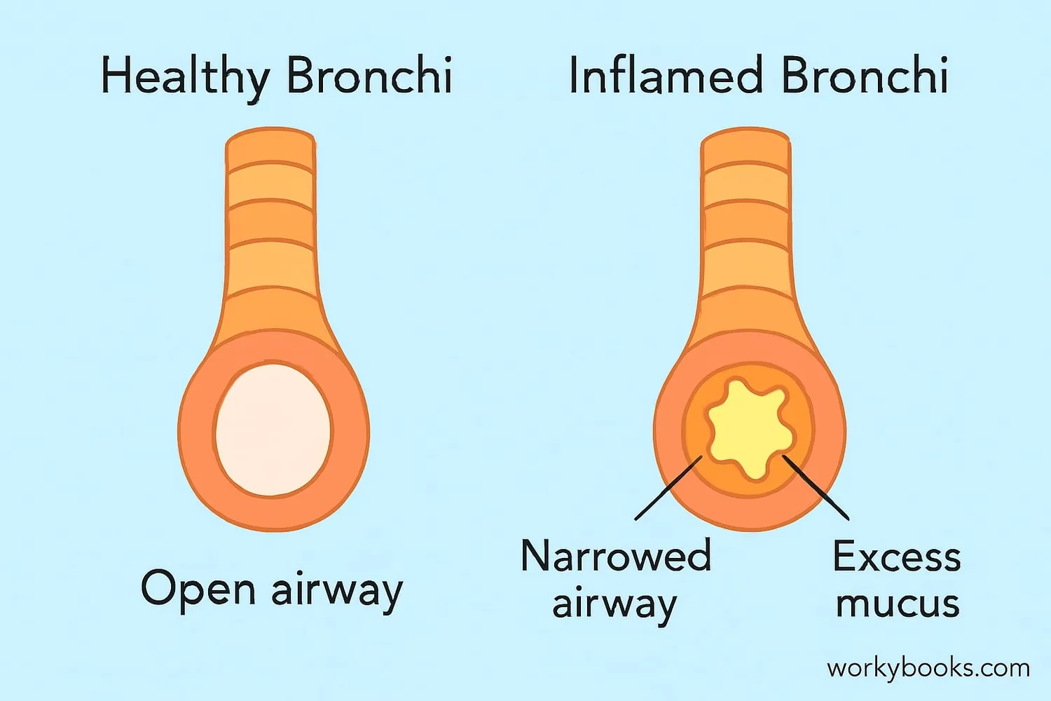 Comparison of healthy bronchi vs. inflamed bronchi during asthma or bronchitis